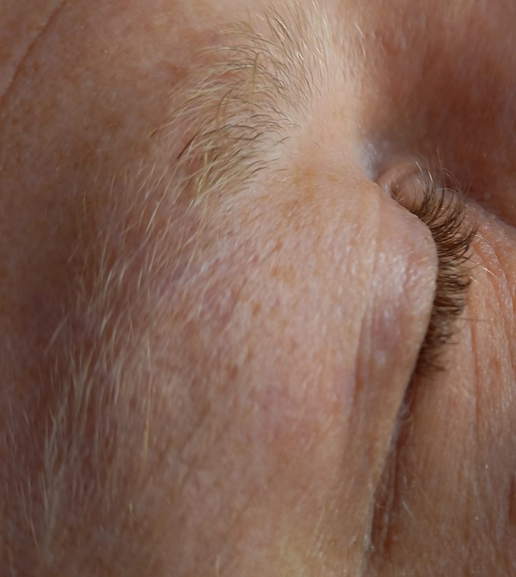 fibromen verwijderen Huid- en Laserkliniek DermaLounge